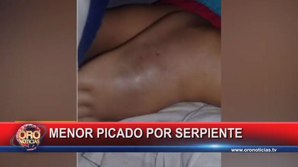 Un niño fue picado por una serpiente talla X en Puerto Wilches