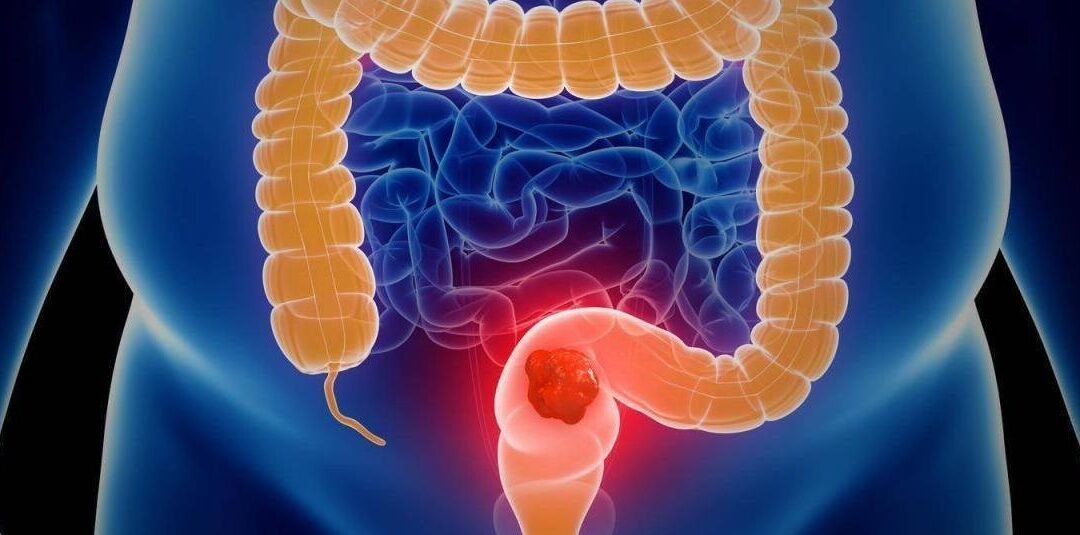 Más de 4.200 casos nuevos de cáncer colorrectal en 2024: cifras preocupan a expertos