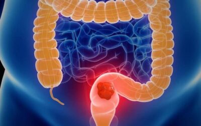 Más de 4.200 casos nuevos de cáncer colorrectal en 2024: cifras preocupan a expertos
