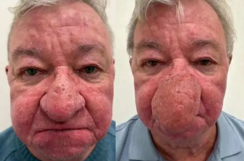 ‘No podía besar a mi esposa’: el testimonio del hombre que recuperó su rostro
