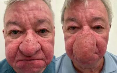 ‘No podía besar a mi esposa’: el testimonio del hombre que recuperó su rostro