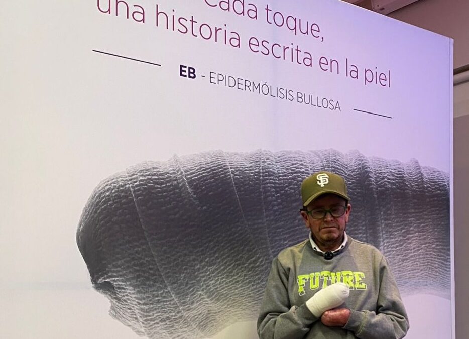 Diagnóstico oportuno, clave para pacientes con Epidermólisis Bullosa