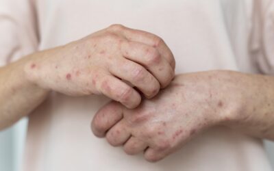 “El sistema trata el lupus como si fuera invisible”: alerta de expertos en Colombia
