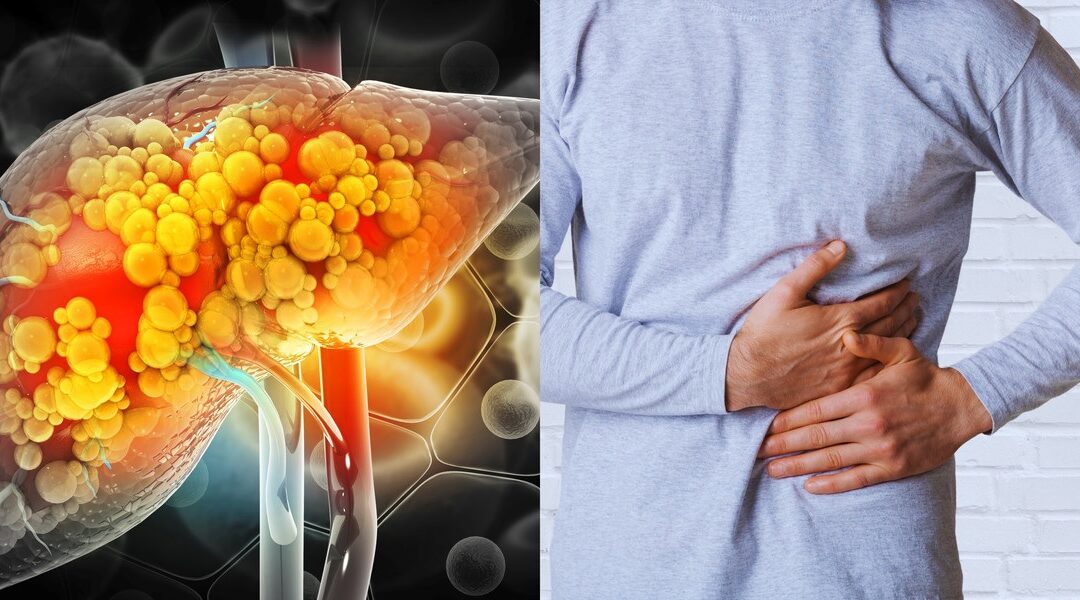 Sobrepeso, diabetes y sedentarismo: factores que elevan el riesgo de hígado graso