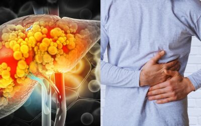 Sobrepeso, diabetes y sedentarismo: factores que elevan el riesgo de hígado graso