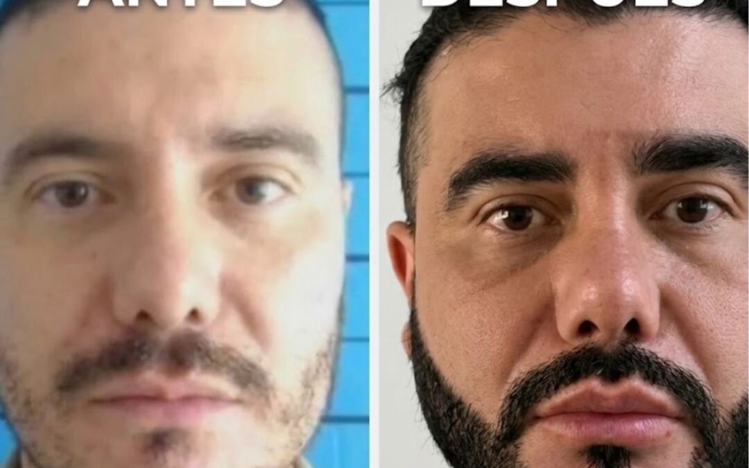 Polémica por autorización de cirugías estéticas dentro la cárcel de La Dorada para alias «Pichi»